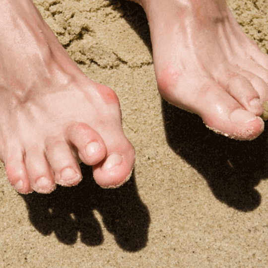 Wann sollte man einen Hallux valgus operieren lassen?